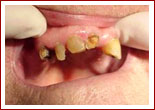 pre oprerative dentures