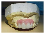 Removable Partial Dentures fram work