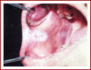 Pecancerous Condition of The Mouth Procedures