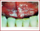 Pecancerous Condition of The Mouth Procedures